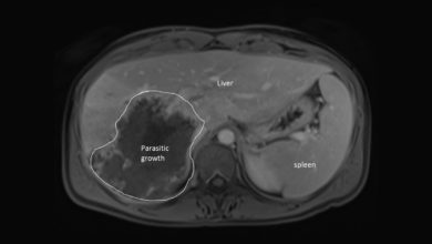 rare liver parasite mri scan